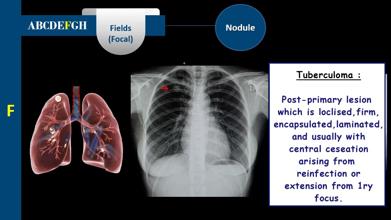 شرح أشعة الصدر | Chest Radiograph | الحلقة السابعة | Focal Lung Lesions