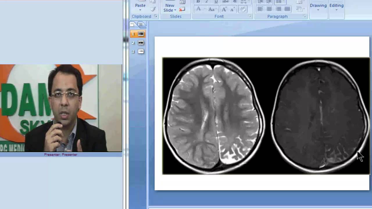Radiology Spotters Part 7 Sturge Weber Syndrome
