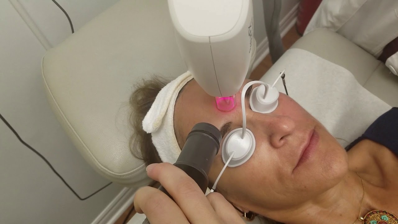 Skin Resurfacing Laser Treatment Demo - (ResurFX by Lumenis M22)