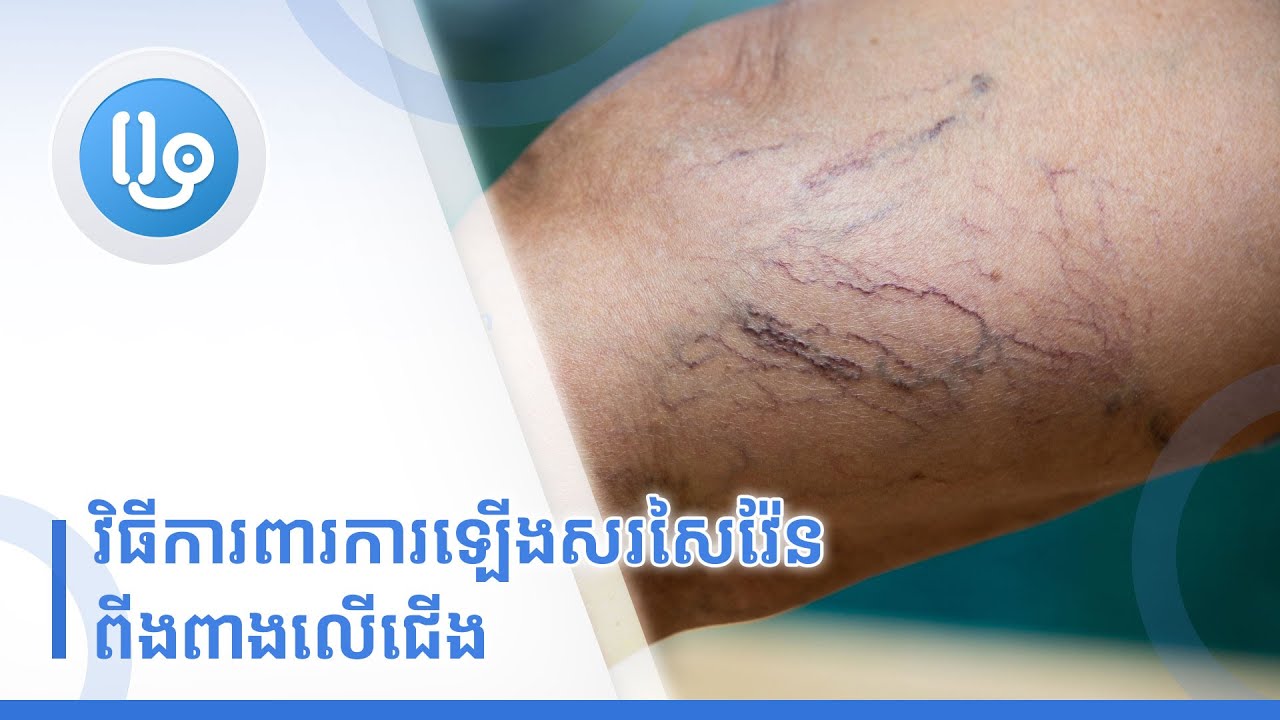 វិធីការពារការឡើងសរសៃវ៉ែនពីងពាងលើជើង