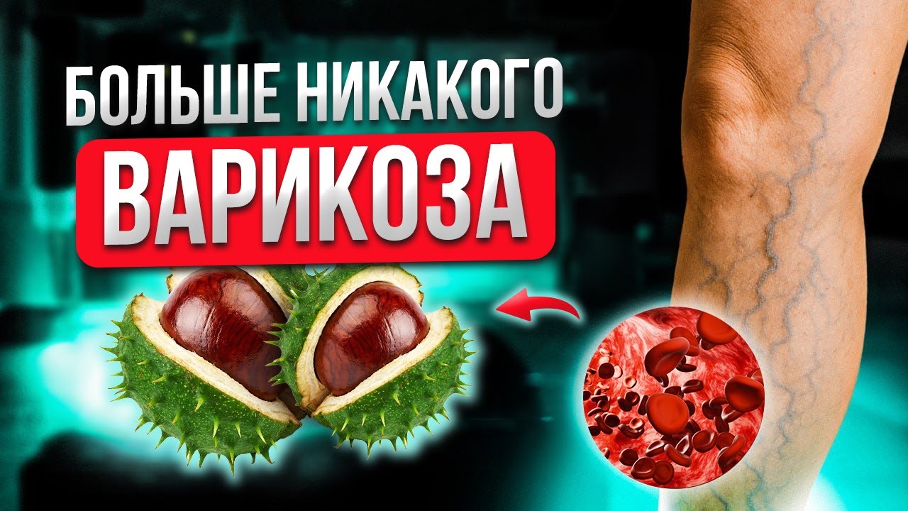 Секретный ИНГРЕДИЕНТ при лечении варикоза! Вы должны знать ЭТО о КОНСКОМ КАШТАНЕ!
