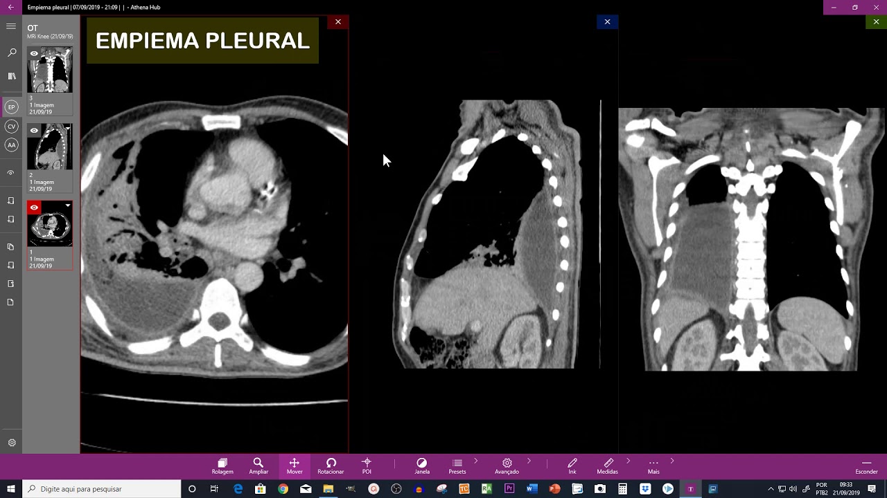 Empiema pleural