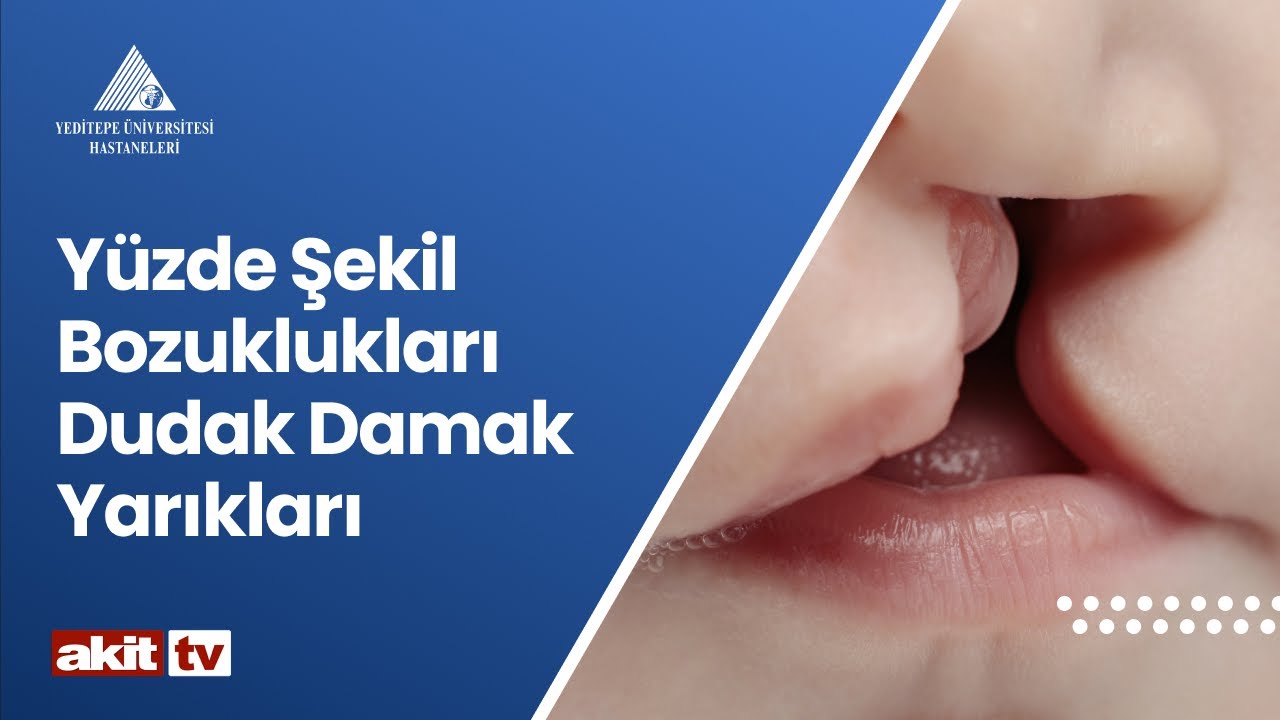Yüzde Şekil Bozuklukları Dudak Damak Yarıkları