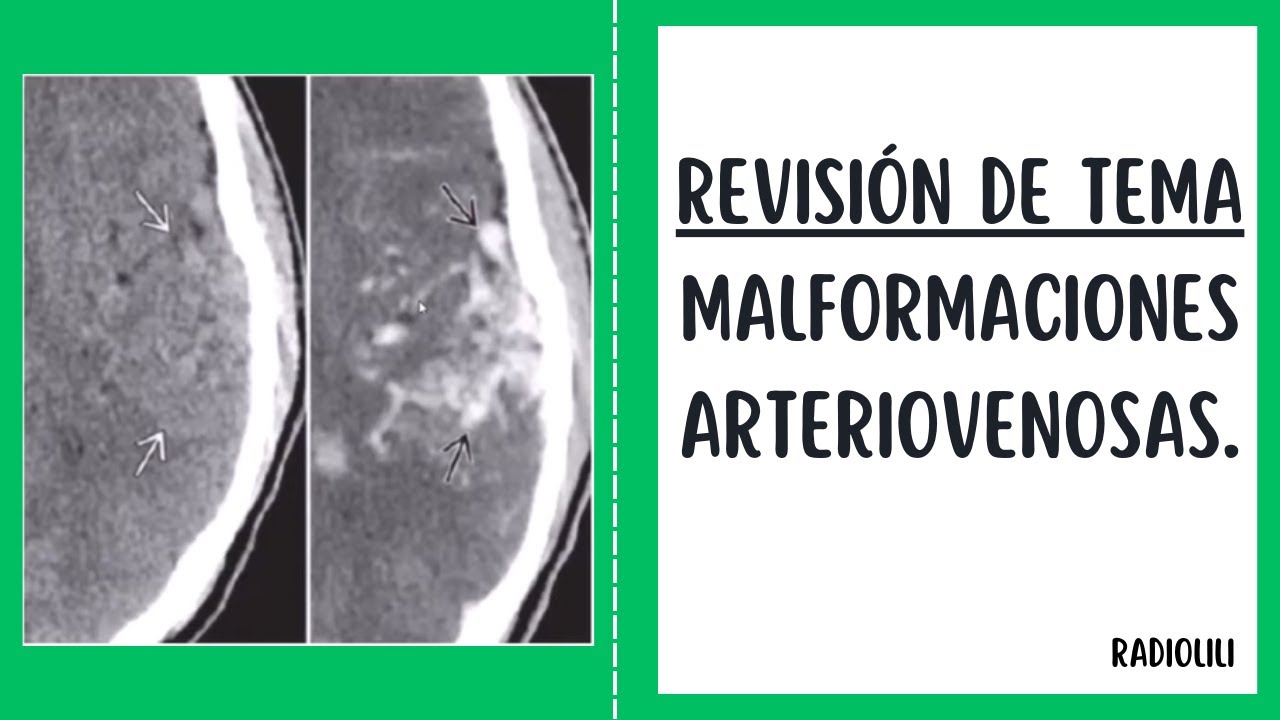 Malformaciones Vasculares: Revisión de Tema.