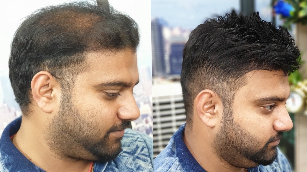 a non surgical hair replacement system for men in delhi  by master RIZY
