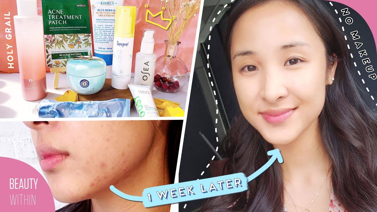 HOLY GRAIL Products to Prevent Breakouts on Acne-Prone & Oily Skin Types
