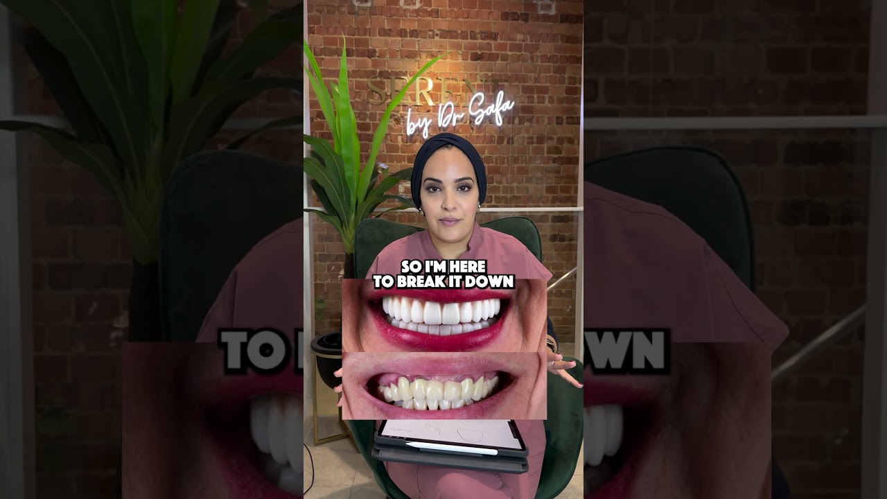 Clarifying misconceptions about veneers! Part-1