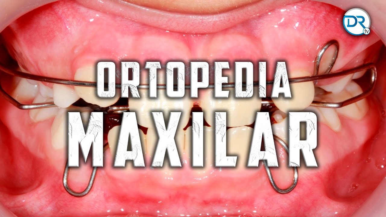 Ortopedia maxilar - DrTv RTU