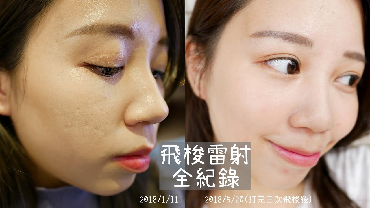 坑洞痘疤走開！飛梭雷射三次全紀錄｜Hanna S.哈娜