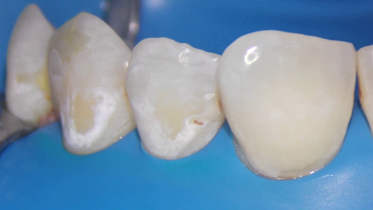 ICON Resin Infiltration step by step Microscopic Dentistry