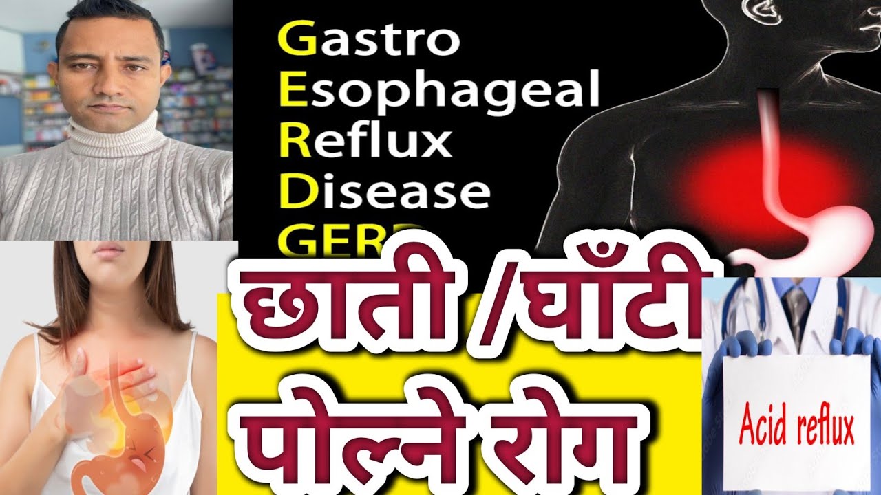 Heart burn problems in Nepali. धेरैलाई हुने छाती /घाँटी पोल्ने समस्या। #reflux