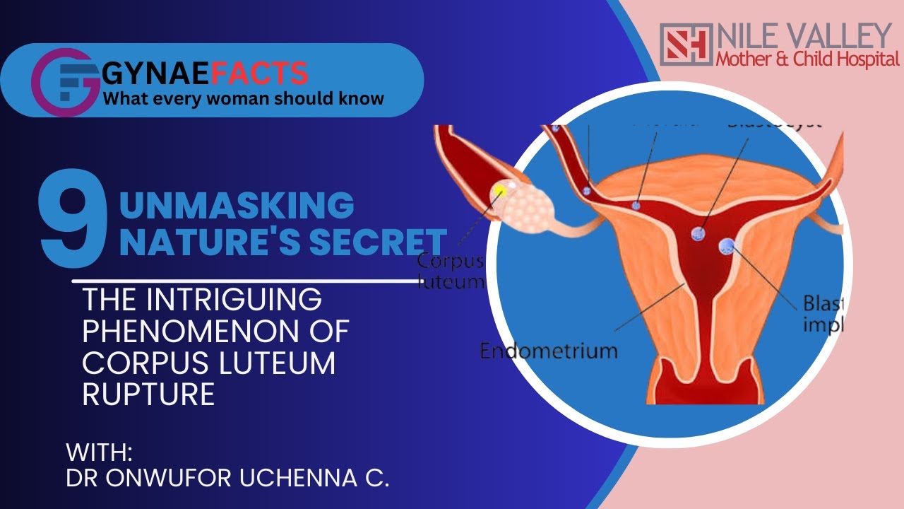 THE INTRIGUING PHENOMENON OF CORPUS LUTEUM RUPTURE: