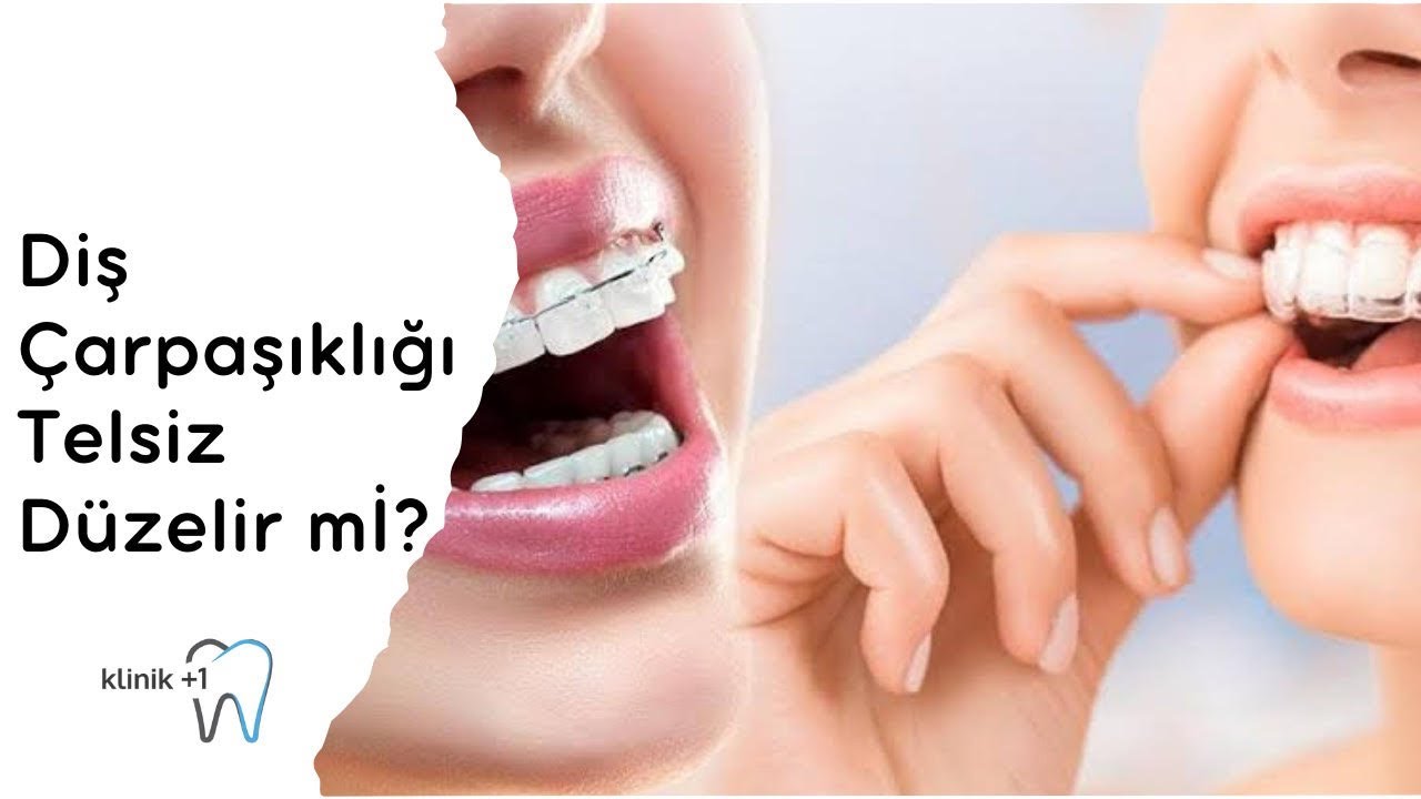 Diş Çarpaşıklığı Telsiz Düzelir mi ?  - İnvisalign Şeffaf Plak Tedavisi Nedir ?