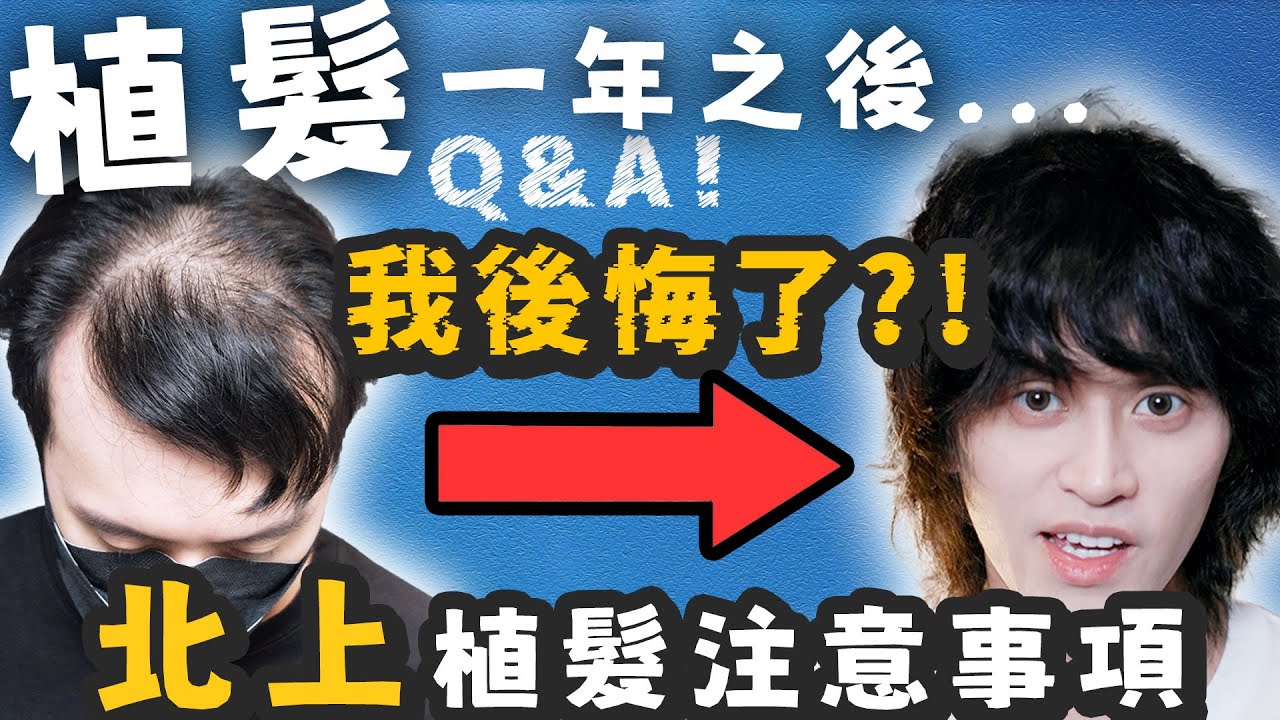 【植髮】北上植髮有什麼注意？植髮一年後我後悔了...一次過解答植髮問題，你們不要再問了Q&A！