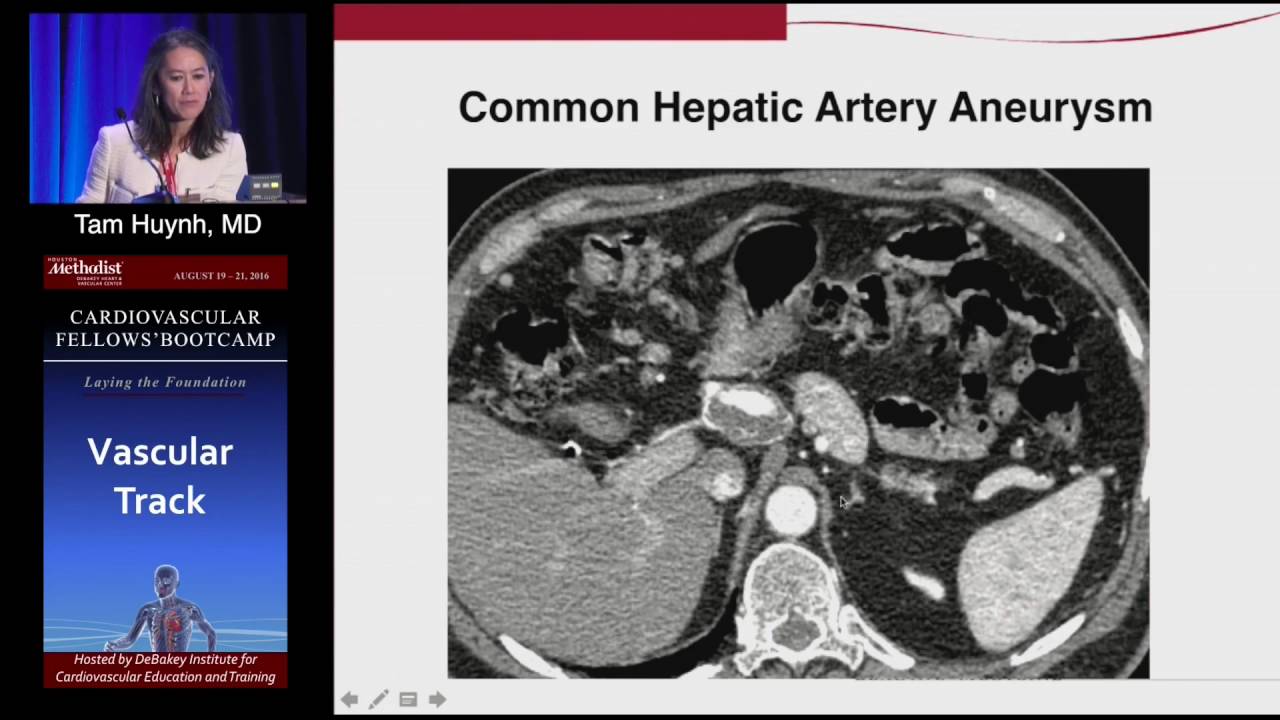 Management of Visceral Artery Aneurysms (Tam Huynh, MD) Sunday, August 21, 2016