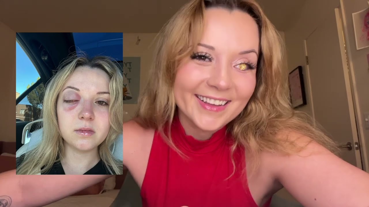 How I Lost My Eye