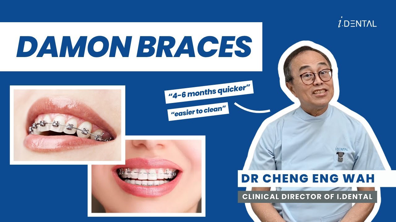 DAMON BRACES vs Traditional Braces — What’s The Difference?