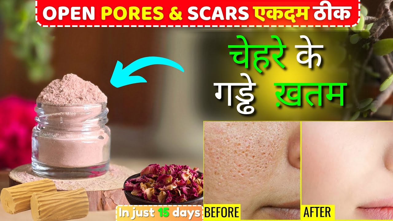 Open pores Home remedy|| How to close Open Pores at home|| Face pack for glowing skin||