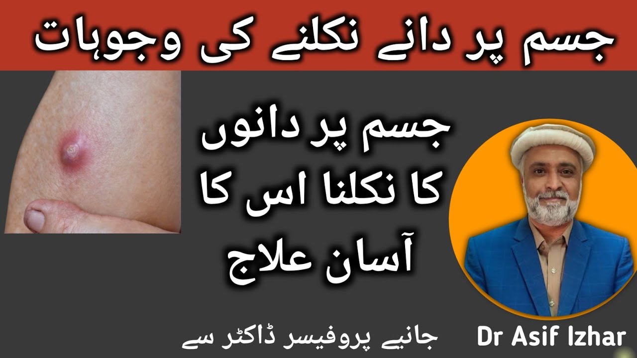 Skin Boils Treatment | Abscess Treatment | Phansi Phoro Ka Ilaj | Jism Par Bar Bar Dano Ka Nikalna