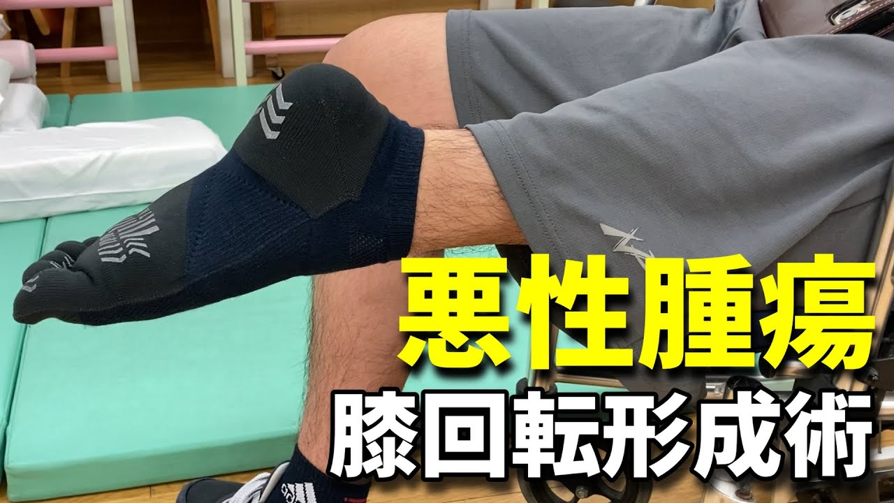 【ローテーションプラスティ】腫瘍で回転形成術を施行した男性【義足で歩く③】