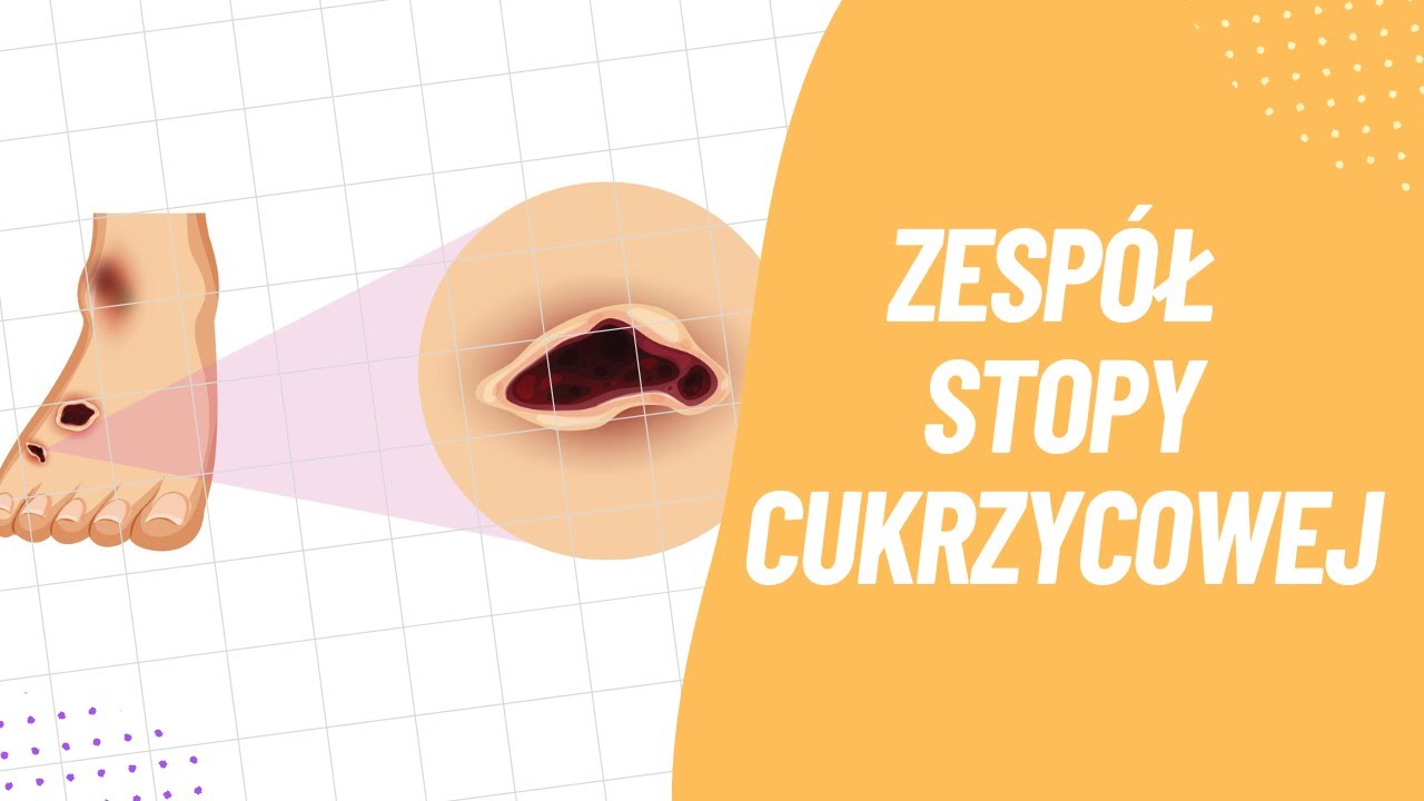 Zespół Stopy Cukrzycowej: Kluczowe Informacje i Profilaktyka