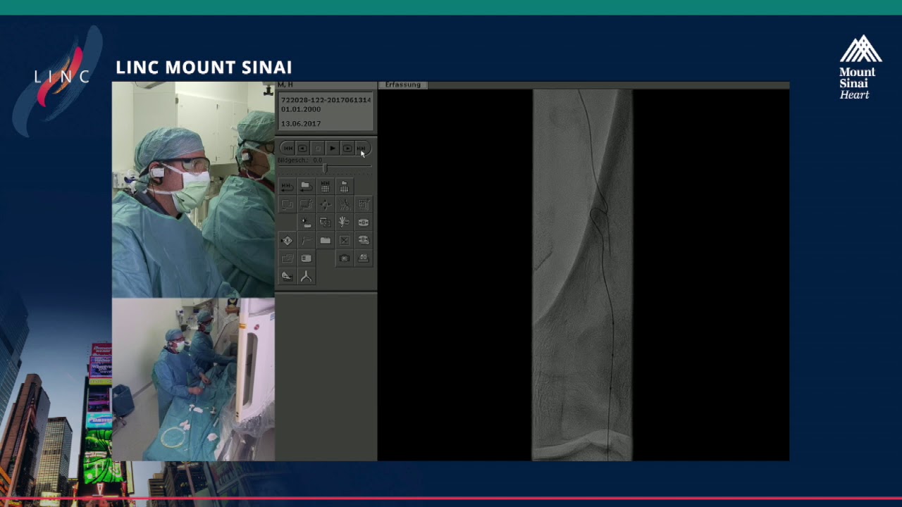 Live Case Presentation #3 RETROGRADE RECANALIZATION OF A FEMORAL POPLITEAL OCCLUSION