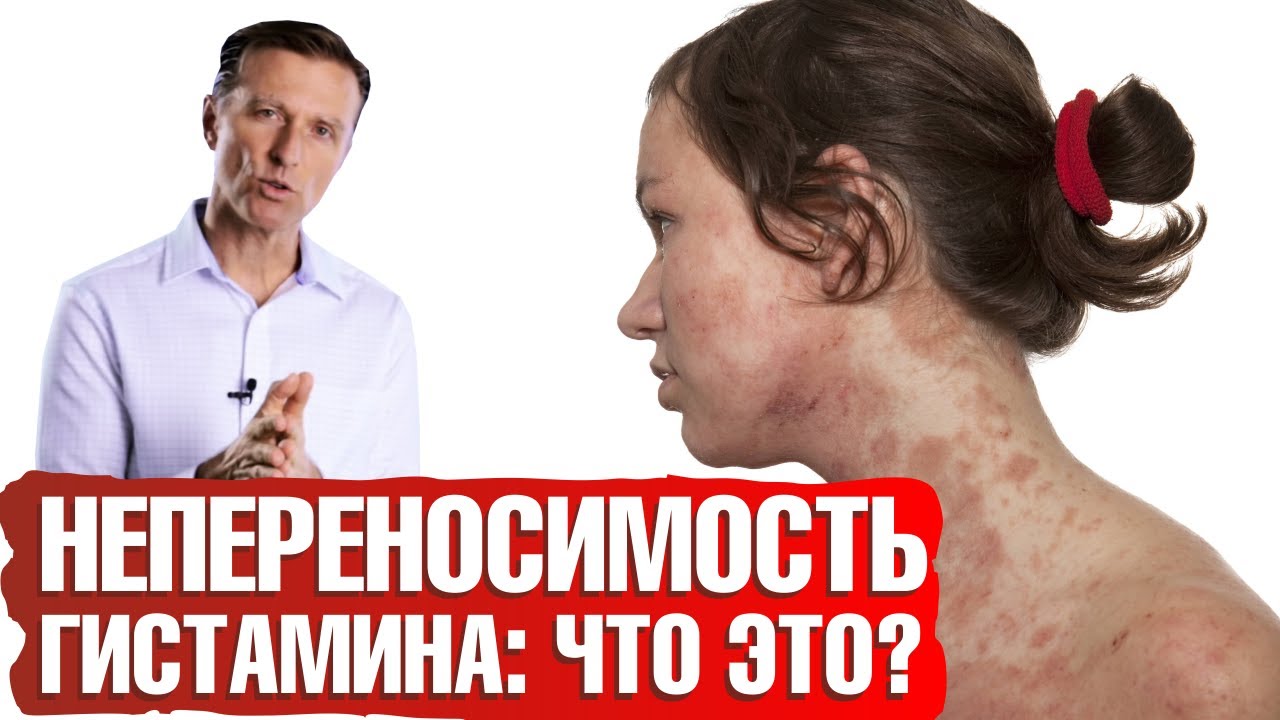 Что такое непереносимость гистамина? Пищевая непереносимость - что делать🤷‍♀️