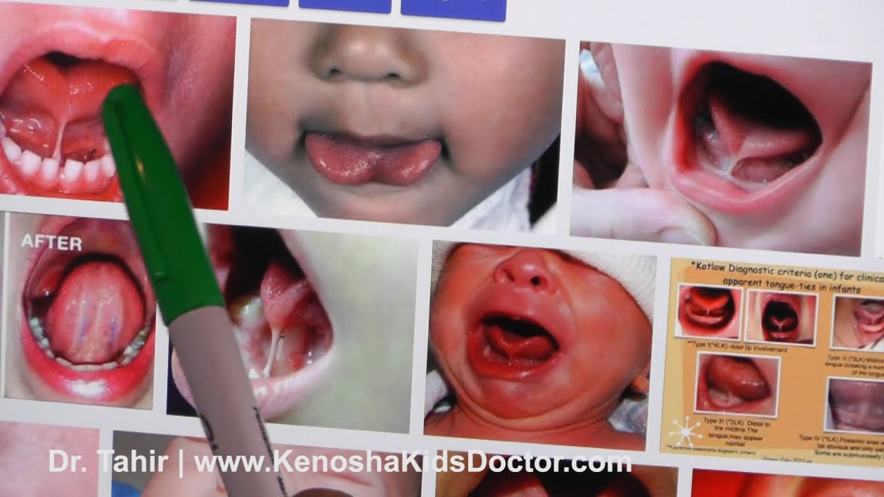 What Is Tongue Tie And What To Do About It