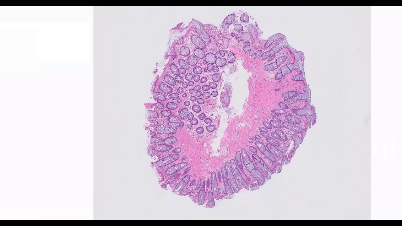 Mucosal prolapse polyp of the colon