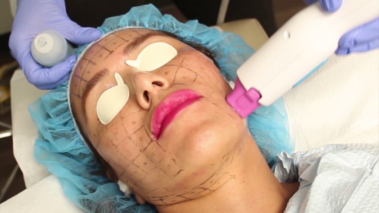 Introducing the New Thermage FLX Skin Treatment