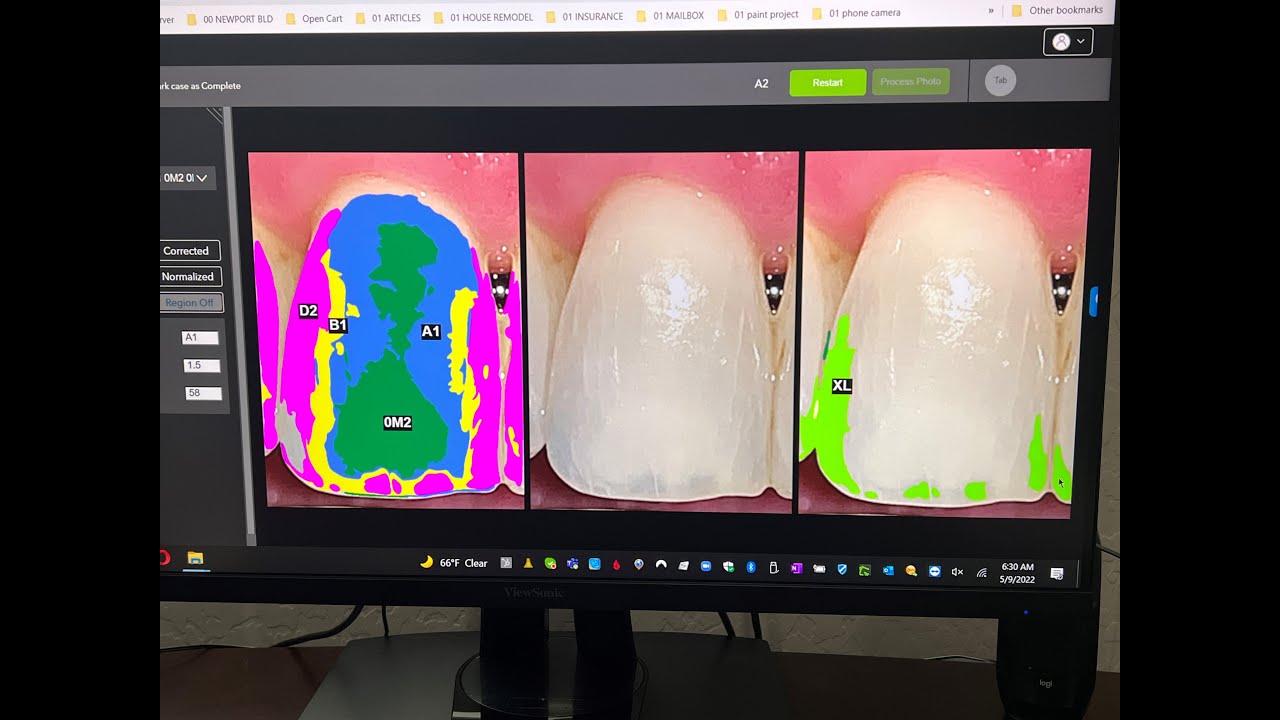 ShadeWave DIGITAL SHADE TAKING, Absolute Dental Lab