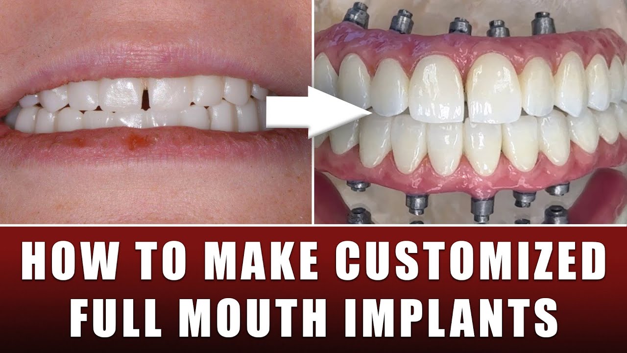 How to make Customized Full Mouth Implants