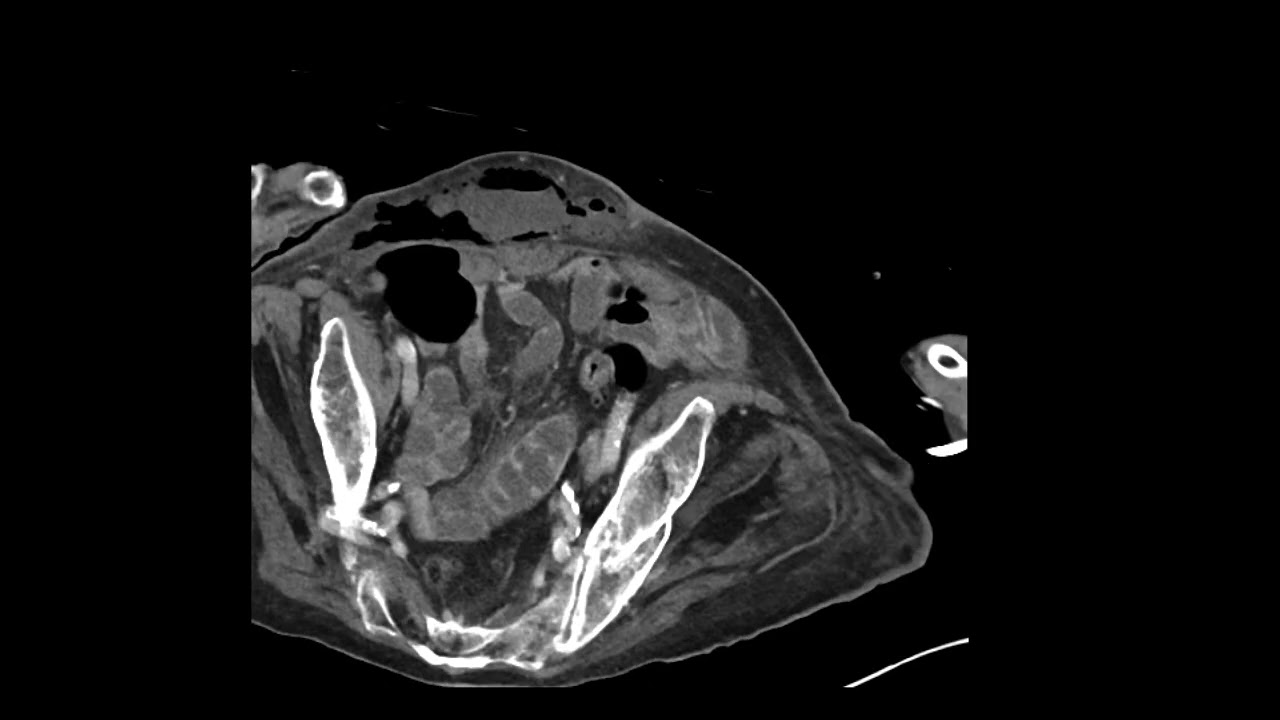 Complicated cholecystitis