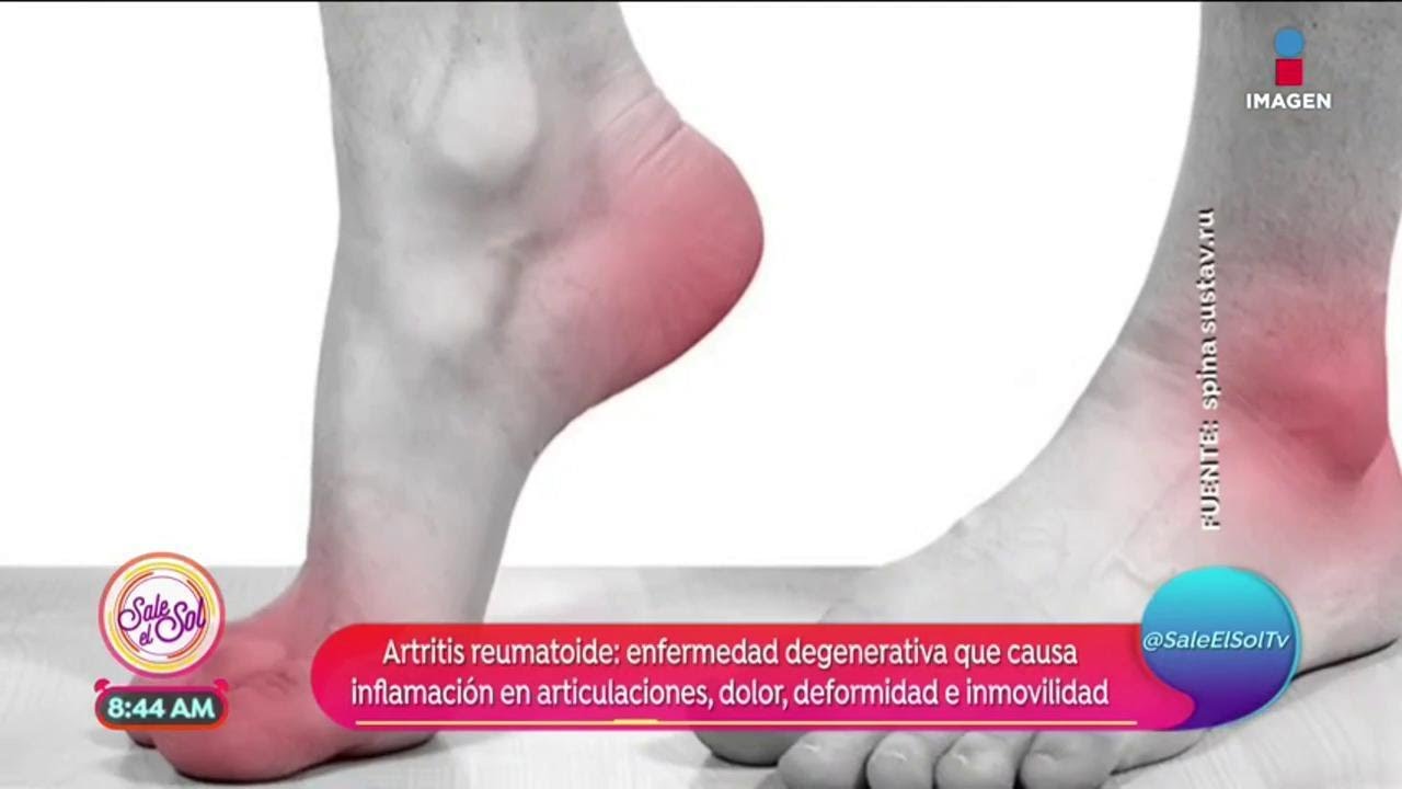 ¿Qué es y cómo se ocasiona la artritis reumatoide? | Sale el Sol