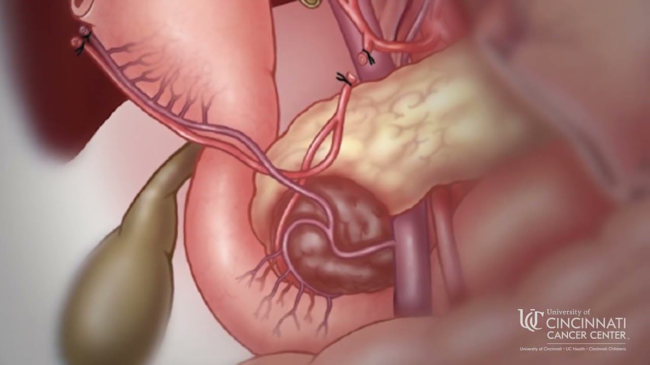 What Is a Whipple Surgery? University of Cincinnati Cancer Center Explains