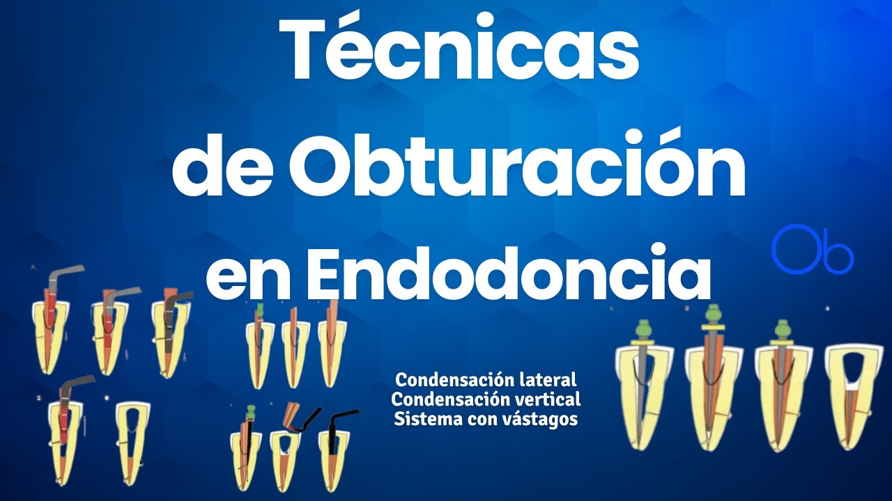 Técnicas de Obturación en Endodoncia 🦷