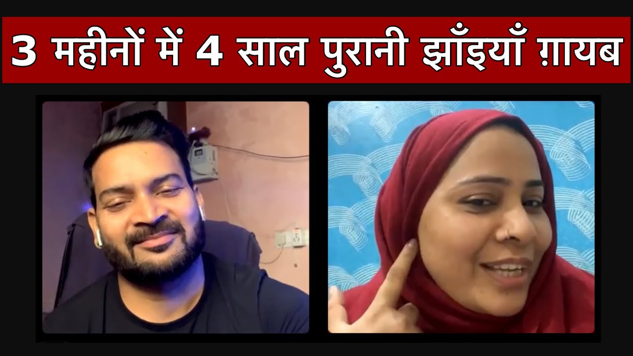 My 4 Year Old Melasma gone in 3 month. 3 महीनों में 4 साल पुरानी झाँइयाँ ग़ायब