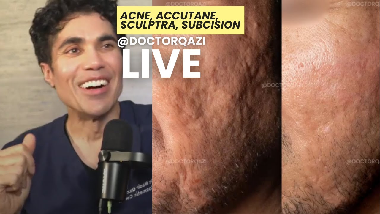 Dr. Qazi discusses Acne, Accutane, Sculptra, Subcision | Dr. Qazi Unsponsored Live | 4.2.2025