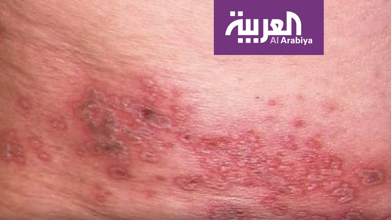 الحزام الناري يظهر بشكل طفح جلدي وهو مرض غير معد