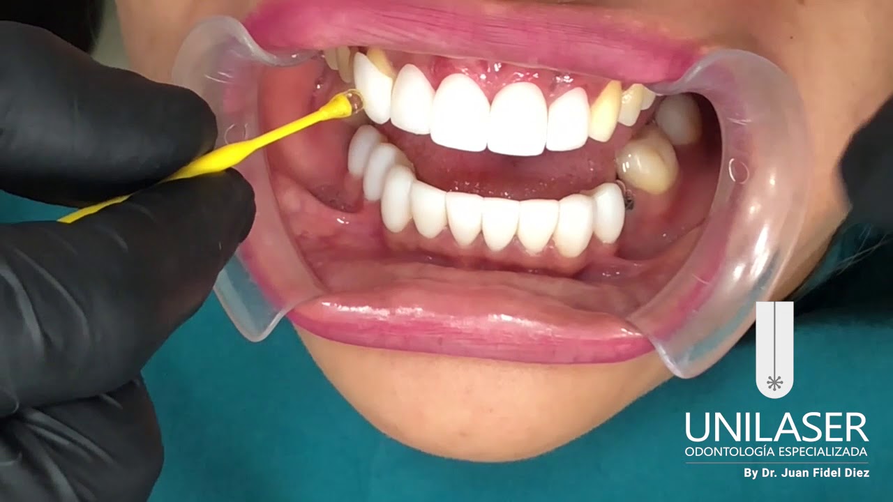 Unilaser   Paso a paso Diseño de Sonrisa Combinado