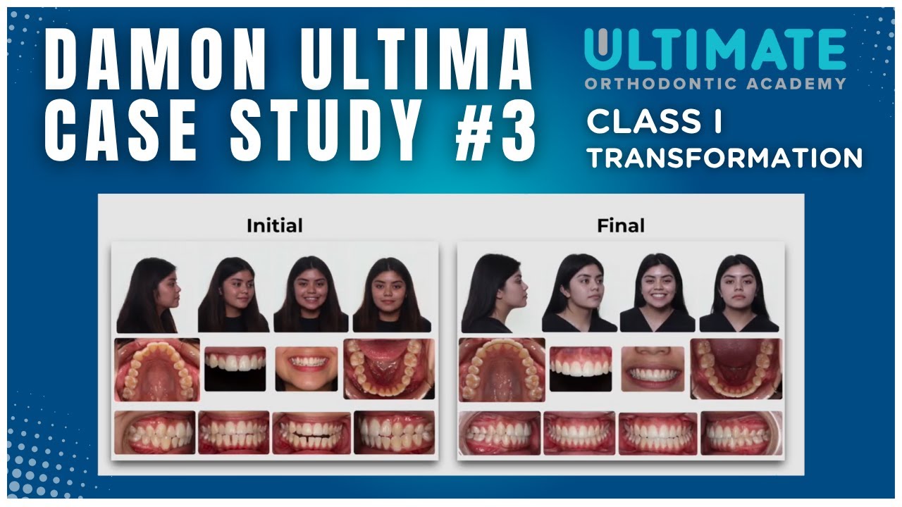 From Crossbite to Perfect Smile | Step-by-Step Damon Ultima Case