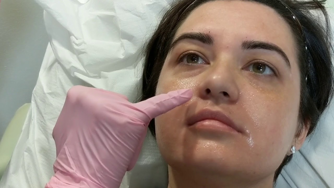 Restylane Lyft