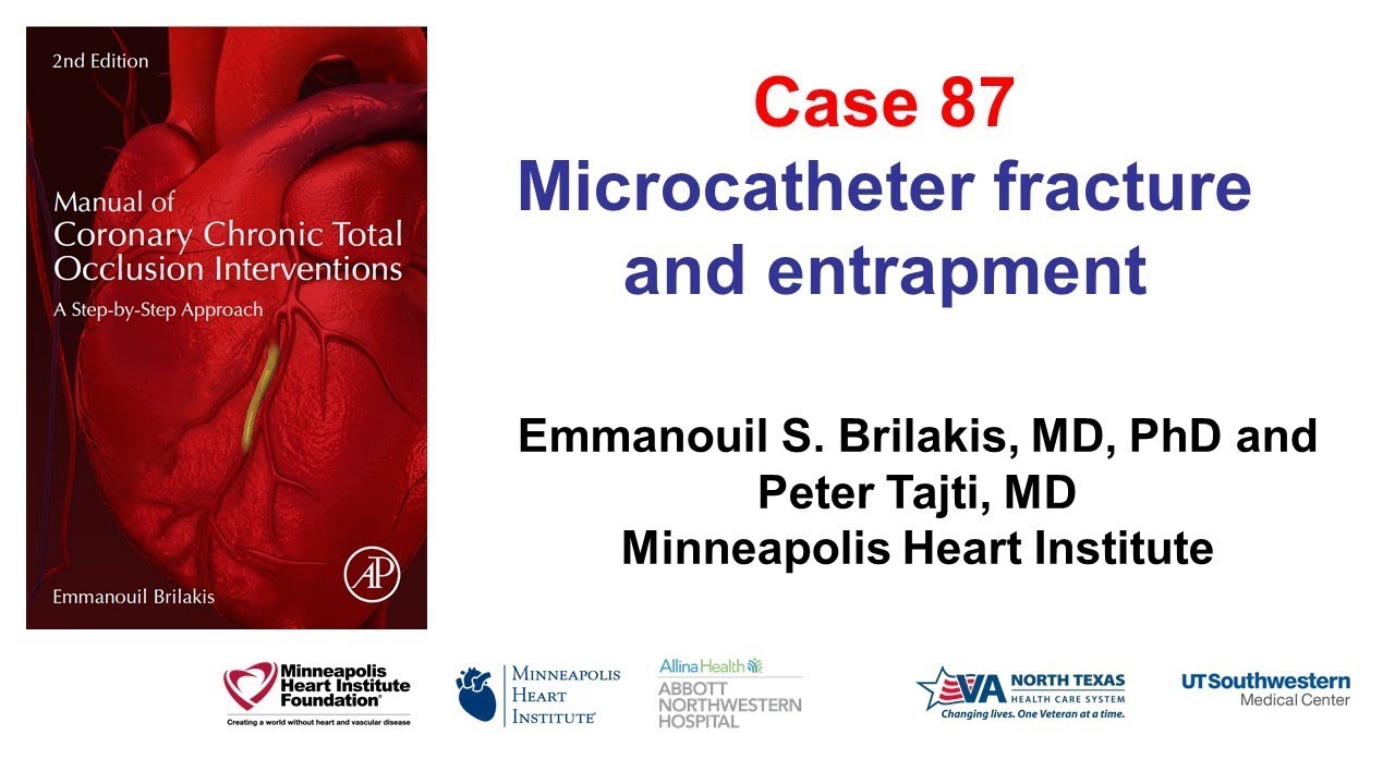 Case 87: Manual of CTO interventions: Microcatheter fracture and entrapment