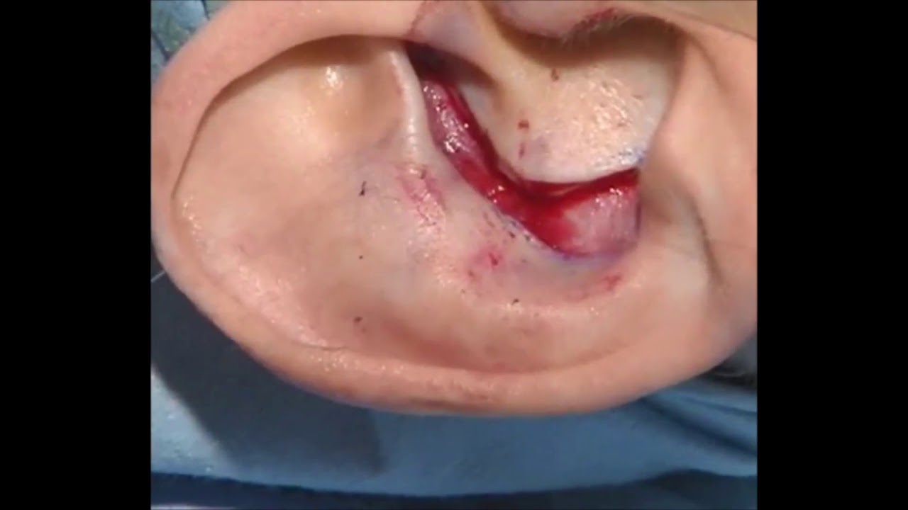 Conchal Auricular Composite Graft Harvest With Primary Closure  - JAMA Facial Plastic Surgery