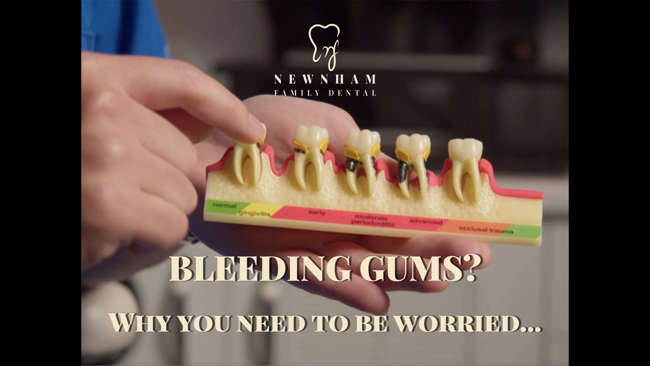 BLEEDING GUMS? Why you need to be worried… #gumdisease #gum #dentist #dentalcare #teeth #oralhealth