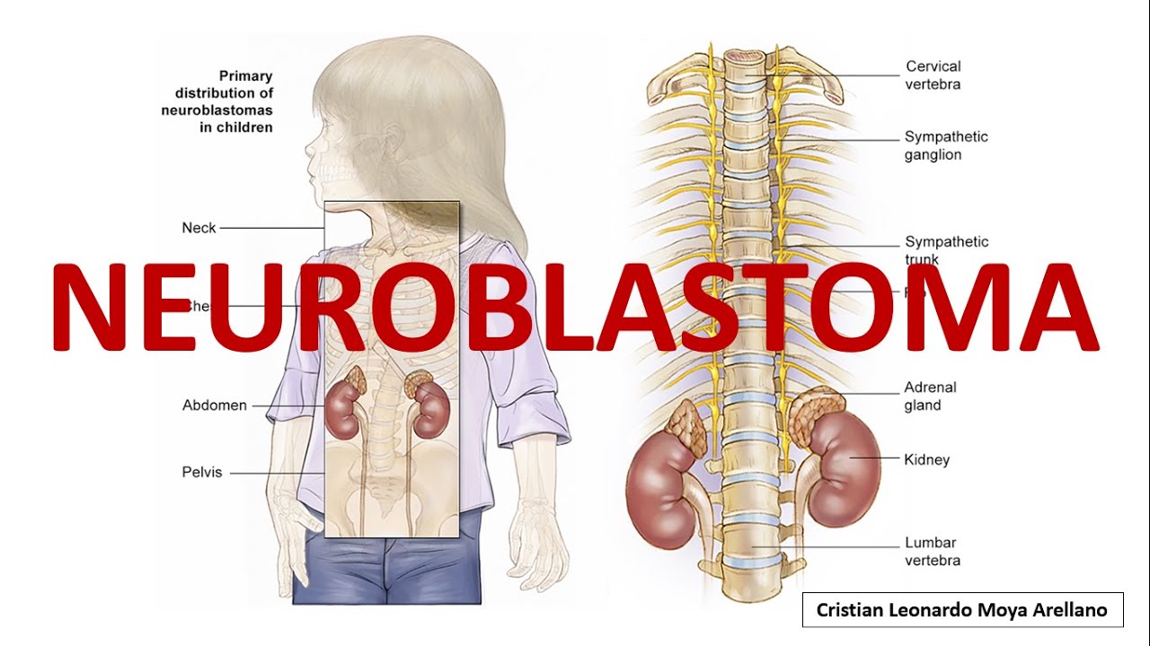 🔴 NEUROBLASTOMA