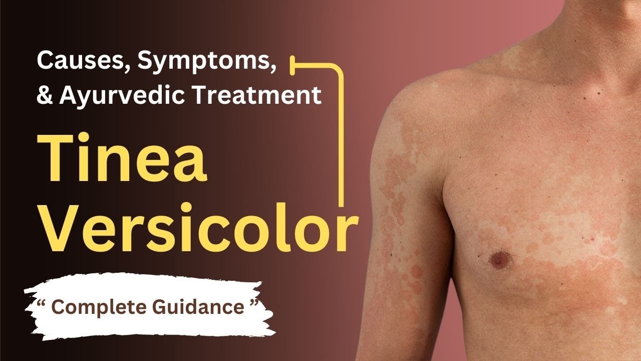 How to Treat Tinea Versicolor with Ayurvedic Medications? Complete Guidance