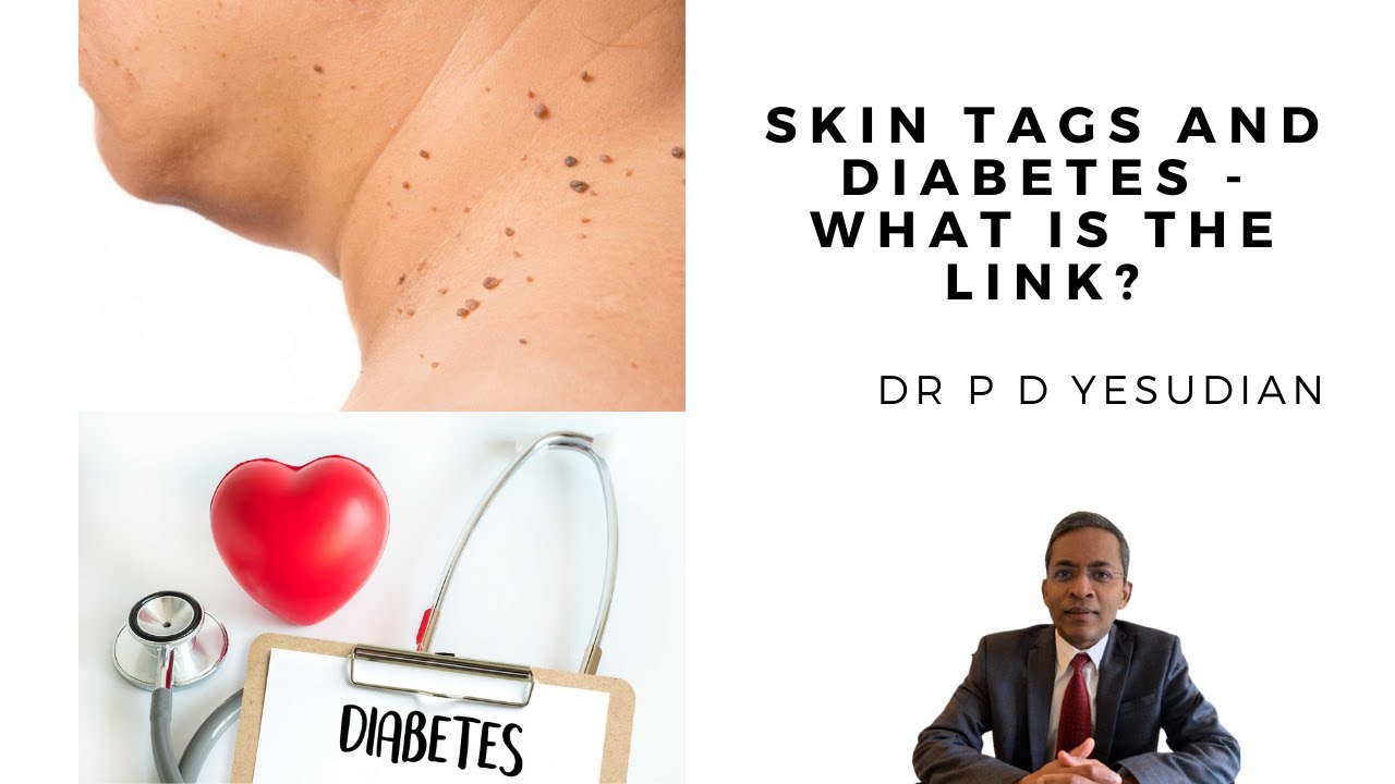 Skin tags and diabetes - what is the link?