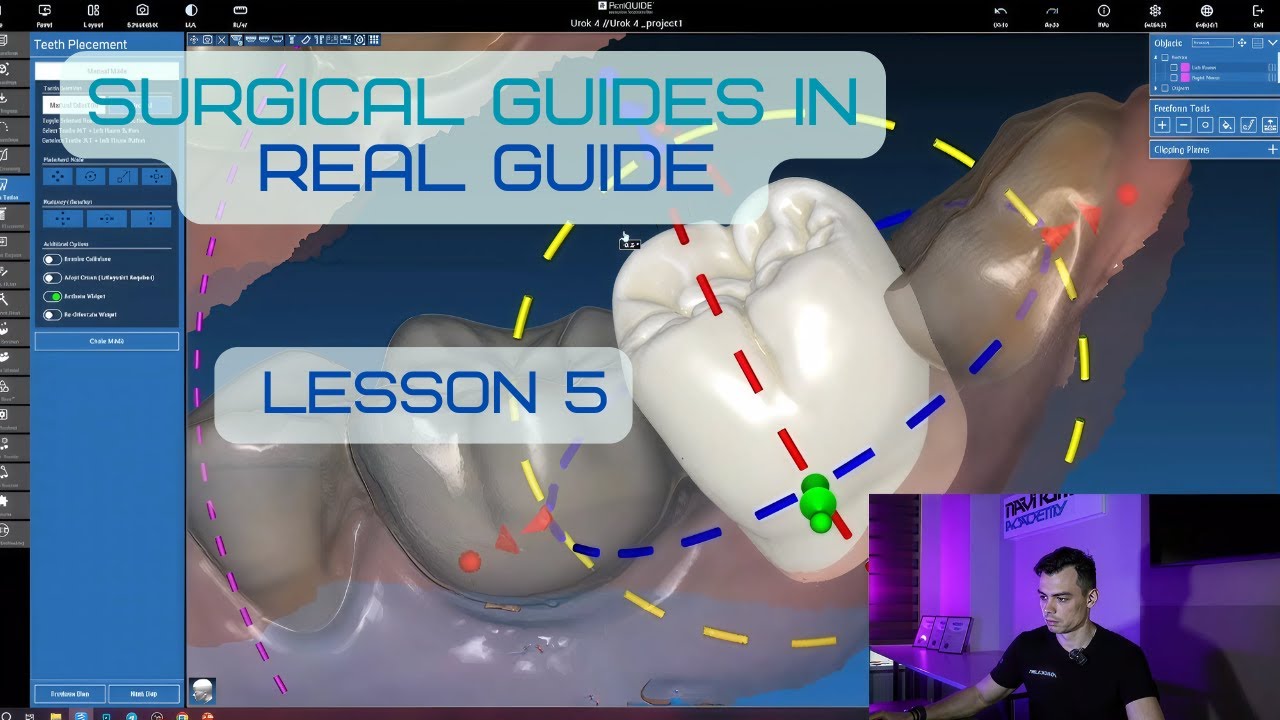 Surgical guides in RealGuide Tutorial. Lesson 5. CT and scans alignment, Waxup setup