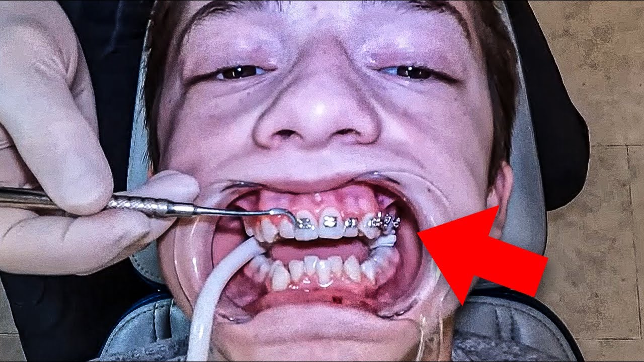 Getting Braces On to Fix a DEEP BITE!!...full process